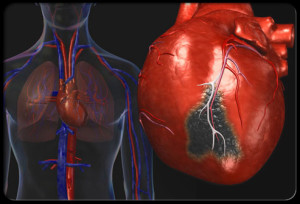 heart-disease-visual-guide-s2-heart-attack